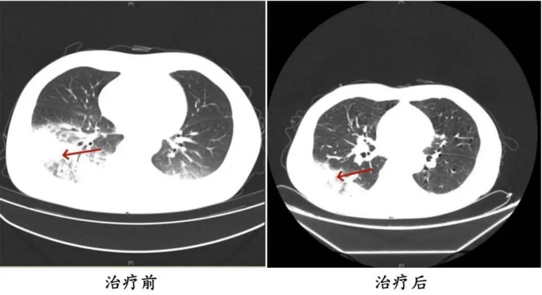 △周先生治疗前后的肺部CT影像 图片
